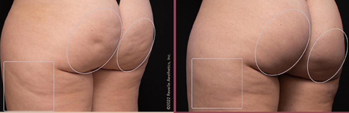 Av&eacute;li vs Cellfina cellulite treatment comparison in San Ramon, CA