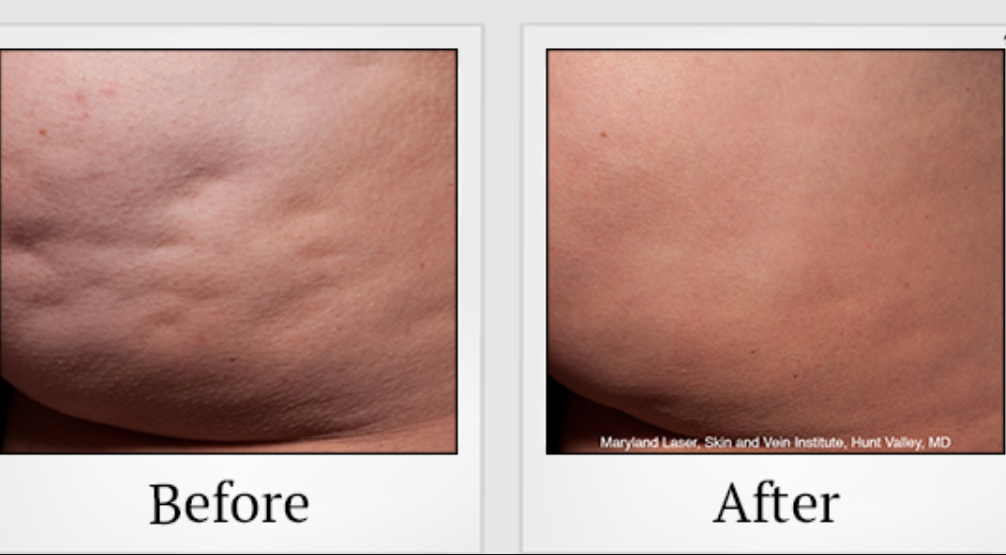 Av&eacute;li and Cellfina cellulite treatment comparison at SF Bay Cosmetic Surgery Medical Group in San Ramon, CA