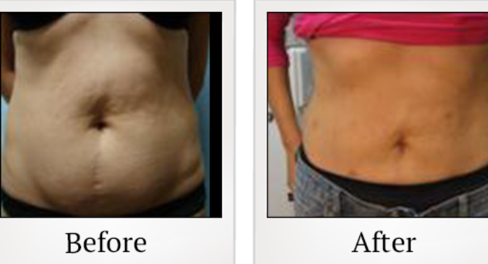 SmartLipo vs traditional liposuction comparison in San Ramon, CA