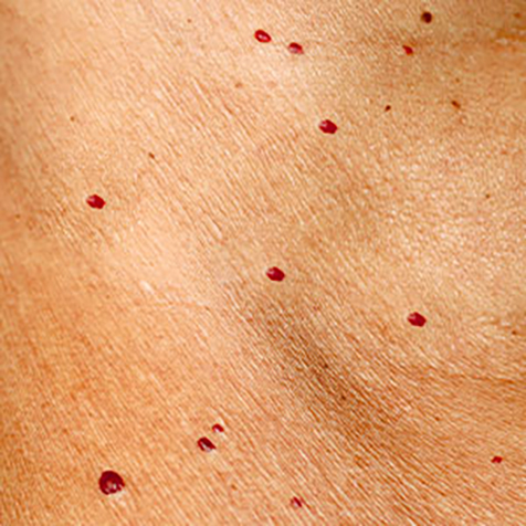 Angiomas treatment options at SF Bay Cosmetic Surgery Medical Group in San Ramon