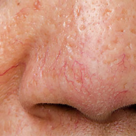Image of patient struggling with Broken Capillaries