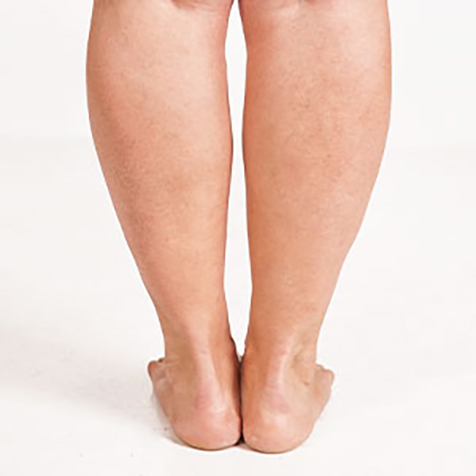 Image of patient struggling with Cankles