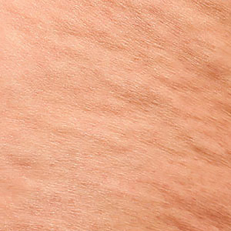 Image of patient struggling with Cellulite