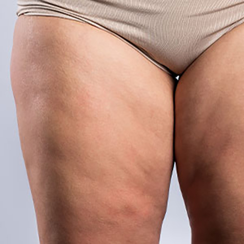 Image of patient struggling with Cottage Cheese Thighs