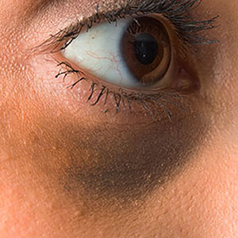 Image of patient struggling with Dark Eye Circles