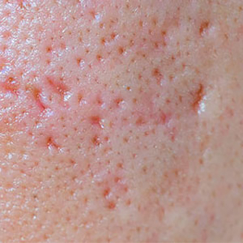 Image of patient struggling with Enlarged Oil Glands & Pores