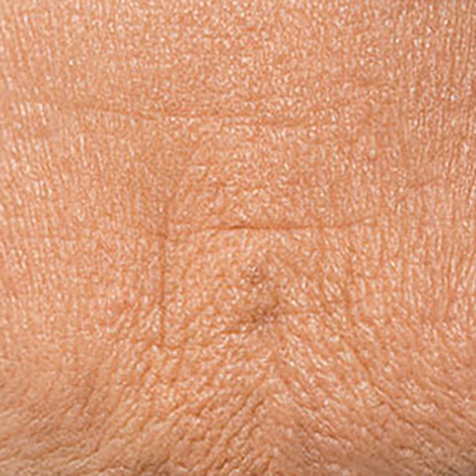 Fine Lines treatment options at SF Bay Cosmetic Surgery Medical Group in San Ramon