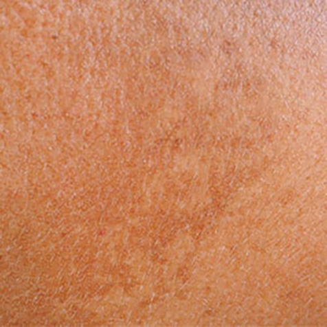 Hyperpigmentation treatment options at SF Bay Cosmetic Surgery Medical Group in San Ramon