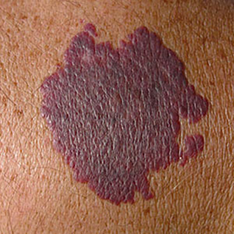 Image of patient struggling with Port-Wine Stains