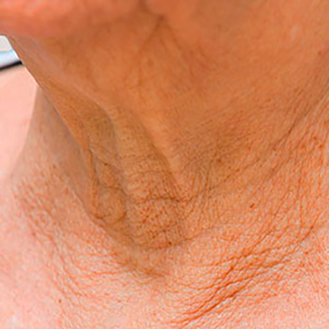 Image of patient struggling with Saggy Skin