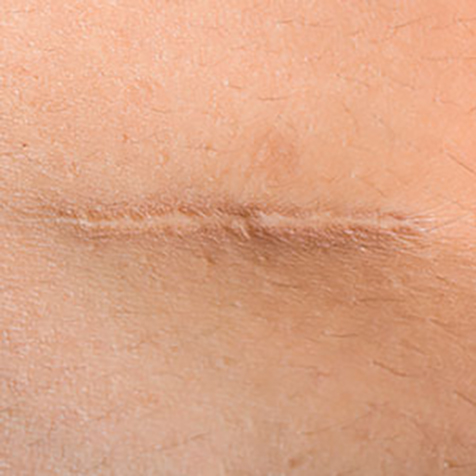 Image of patient struggling with Scarring