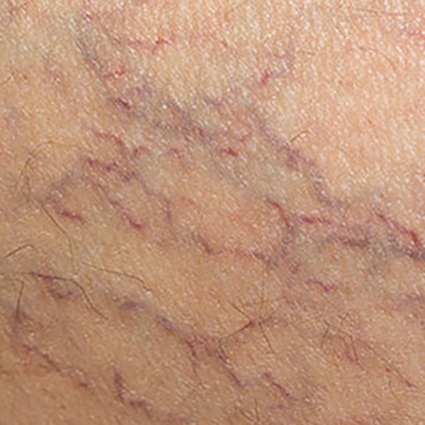 Image of patient struggling with Spider Veins