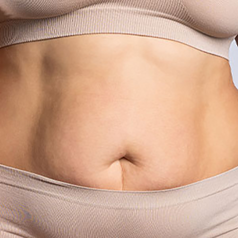 Image of patient struggling with Stubborn Fat