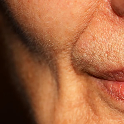 Image of patient struggling with Sunken Cheeks