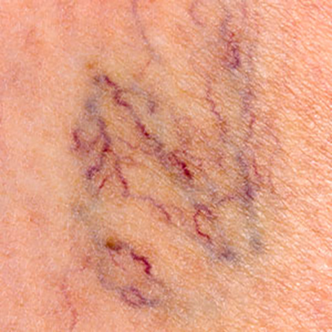 Image of patient struggling with Telangiectasia