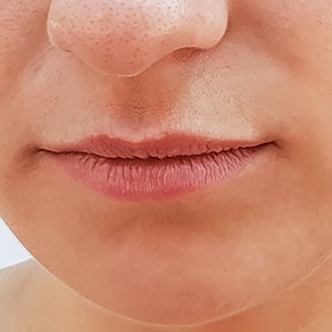 Thin Lips treatment options at SF Bay Cosmetic Surgery Medical Group in San Ramon