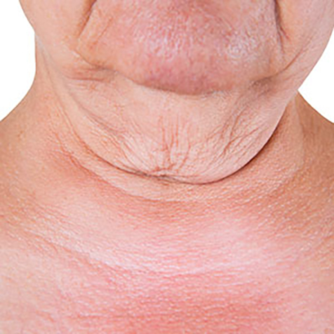 Image of patient struggling with Turkey Neck