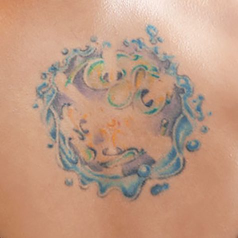 Image of patient struggling with a Unwanted Tattoo
