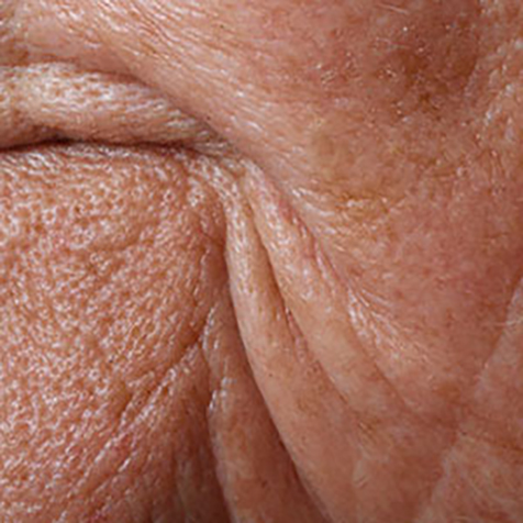 Wrinkles treatment options at SF Bay Cosmetic Surgery Medical Group in San Ramon