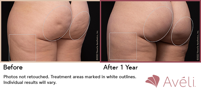 Before and After Photo 1 of Aveli® treatment at SF Bay Cosmetic Surgery Medical Group in San Ramon
