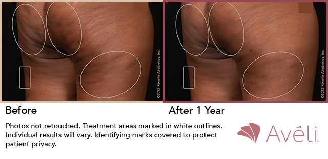 Before and After Photo 1 of Aveli® treatment at SF Bay Cosmetic Surgery Medical Group in San Ramon
