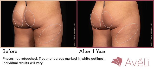 Before and After Photo 1 of Aveli® treatment at SF Bay Cosmetic Surgery Medical Group in San Ramon
