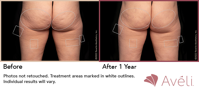 Before and After Photo 1 of Aveli® treatment at SF Bay Cosmetic Surgery Medical Group in San Ramon