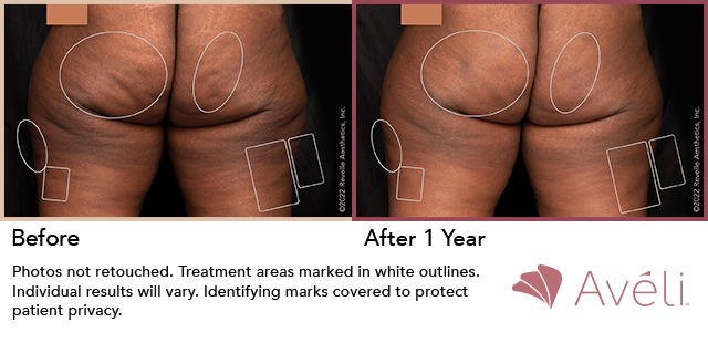 Before and After Photo 1 of Aveli® treatment at SF Bay Cosmetic Surgery Medical Group in San Ramon