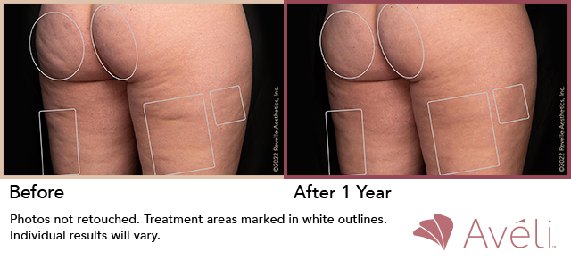 Before and After Photo 1 of Aveli® treatment at SF Bay Cosmetic Surgery Medical Group in San Ramon