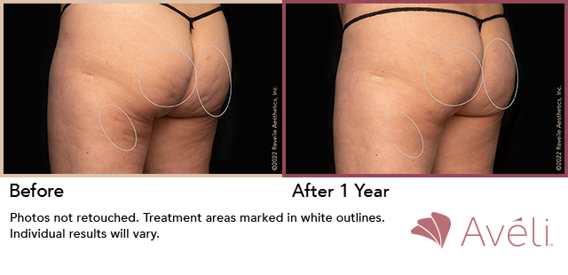 Before and After Photo 1 of Aveli® treatment at SF Bay Cosmetic Surgery Medical Group in San Ramon
