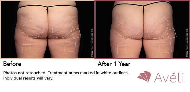 Before and After Photo 1 of Aveli® treatment at SF Bay Cosmetic Surgery Medical Group in San Ramon