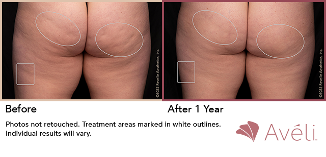 Before and After Photo 1 of Aveli® treatment at SF Bay Cosmetic Surgery Medical Group in San Ramon