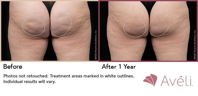 Before and After Photo 1 of Aveli® treatment at SF Bay Cosmetic Surgery Medical Group in San Ramon