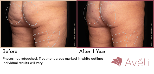 Before and After Photo 1 of Aveli® treatment at SF Bay Cosmetic Surgery Medical Group in San Ramon