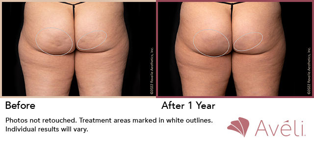 Before and After Photo 1 of Aveli® treatment at SF Bay Cosmetic Surgery Medical Group in San Ramon