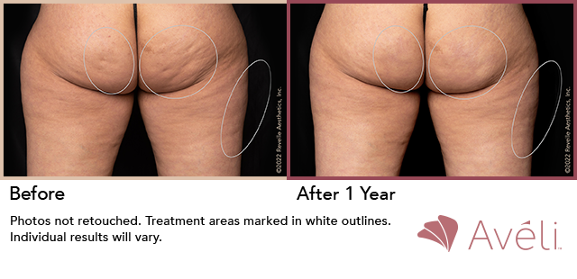 Before and After Photo 1 of Aveli® treatment at SF Bay Cosmetic Surgery Medical Group in San Ramon