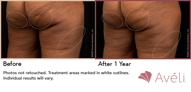 Before and After Photo 1 of Aveli® treatment at SF Bay Cosmetic Surgery Medical Group in San Ramon