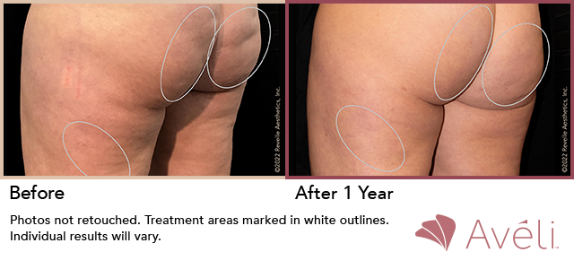 Before and After Photo 1 of Aveli® treatment at SF Bay Cosmetic Surgery Medical Group in San Ramon