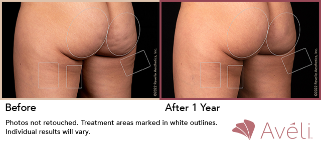 Before and After Photo 1 of Aveli® treatment at SF Bay Cosmetic Surgery Medical Group in San Ramon