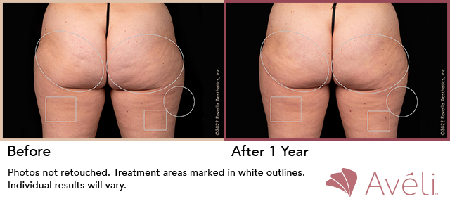Before and After Photo 1 of Aveli® treatment at SF Bay Cosmetic Surgery Medical Group in San Ramon
