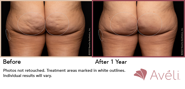 Before and After Photo 1 of Aveli® treatment at SF Bay Cosmetic Surgery Medical Group in San Ramon