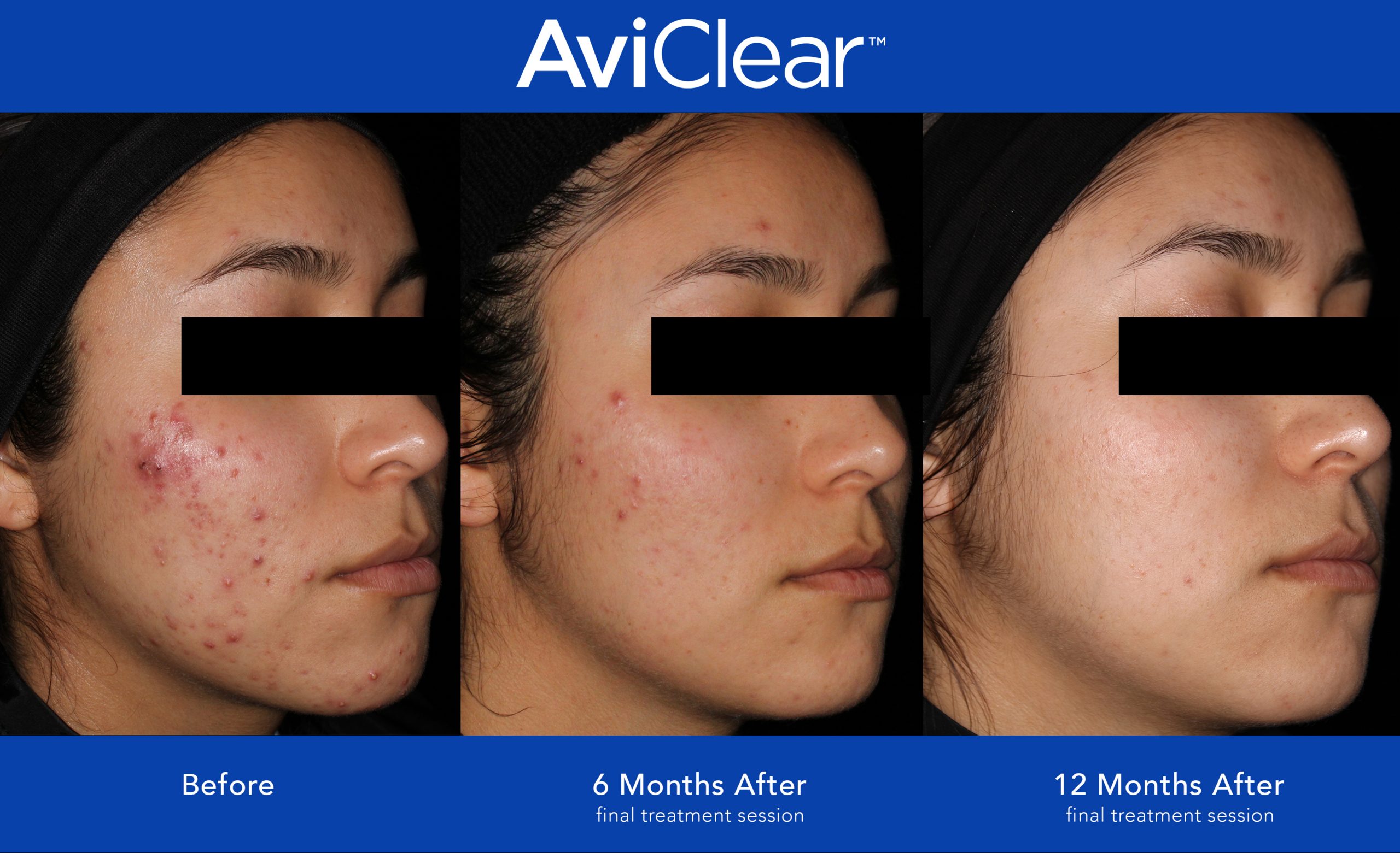 Before and After Photo 1 of AviClear® treatment at SF Bay Cosmetic Surgery Medical Group in San Ramon