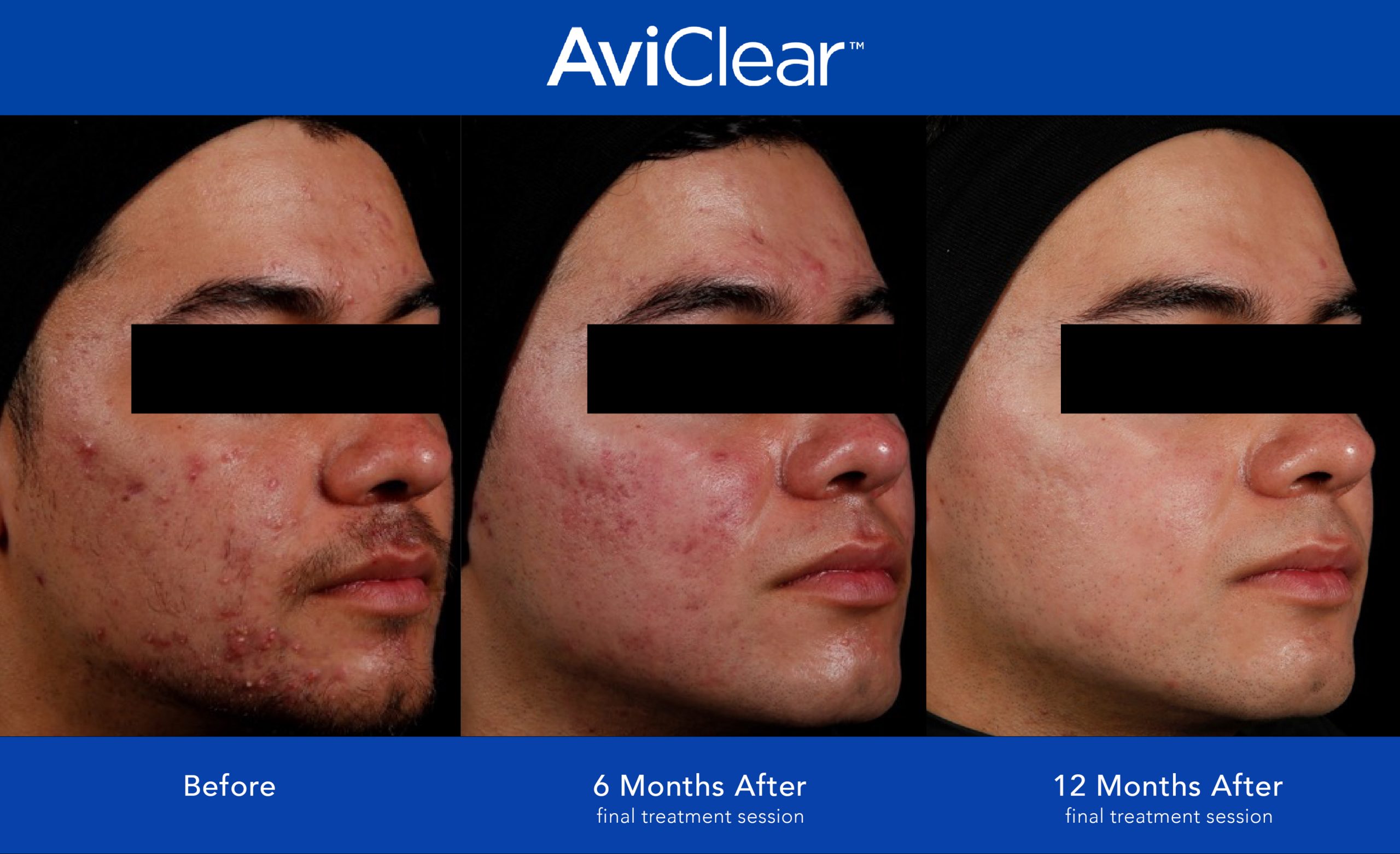 Before and After Photo 2 of AviClear® treatment at SF Bay Cosmetic Surgery Medical Group in San Ramon