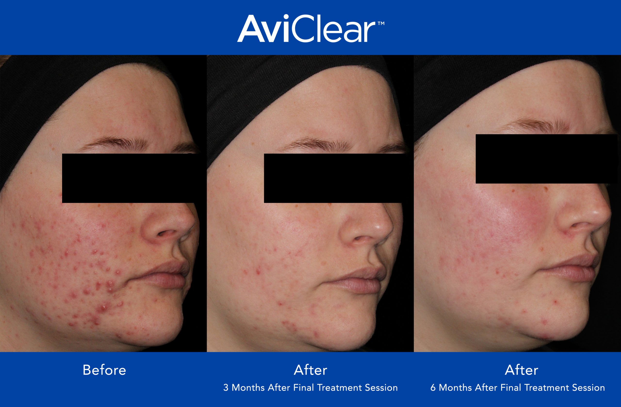 Before and After Photo 1 of AviClear® treatment at SF Bay Cosmetic Surgery Medical Group in San Ramon