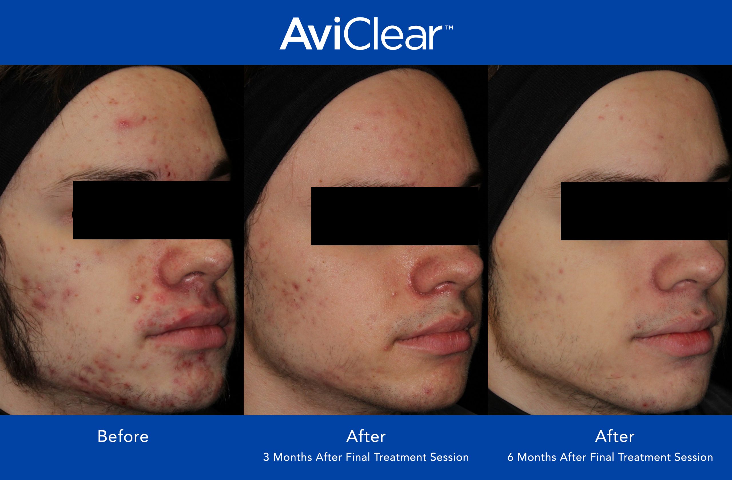 Before and After Photo 1 of AviClear® treatment at SF Bay Cosmetic Surgery Medical Group in San Ramon