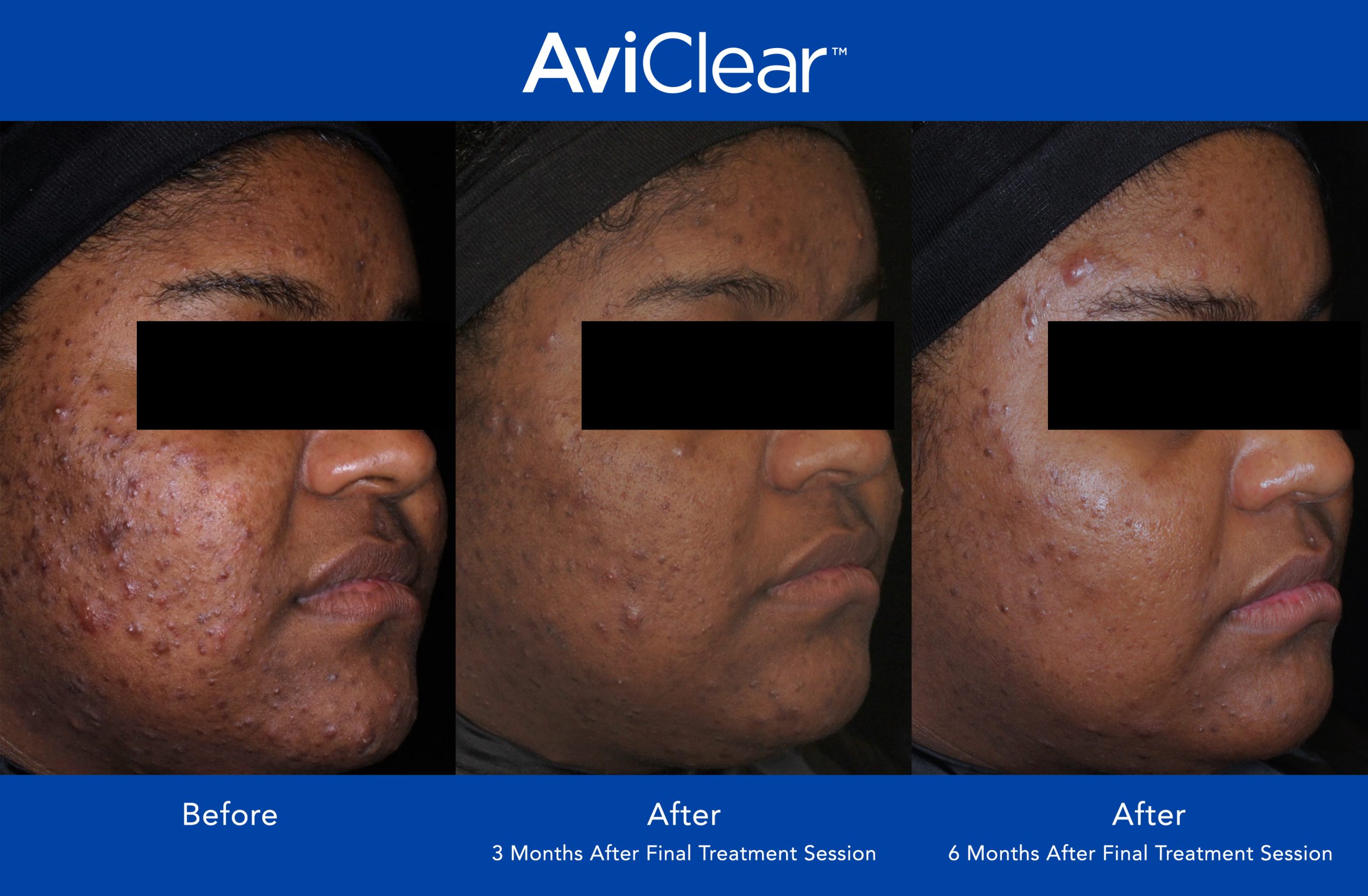 Before and After Photo 1 of AviClear® treatment at SF Bay Cosmetic Surgery Medical Group in San Ramon