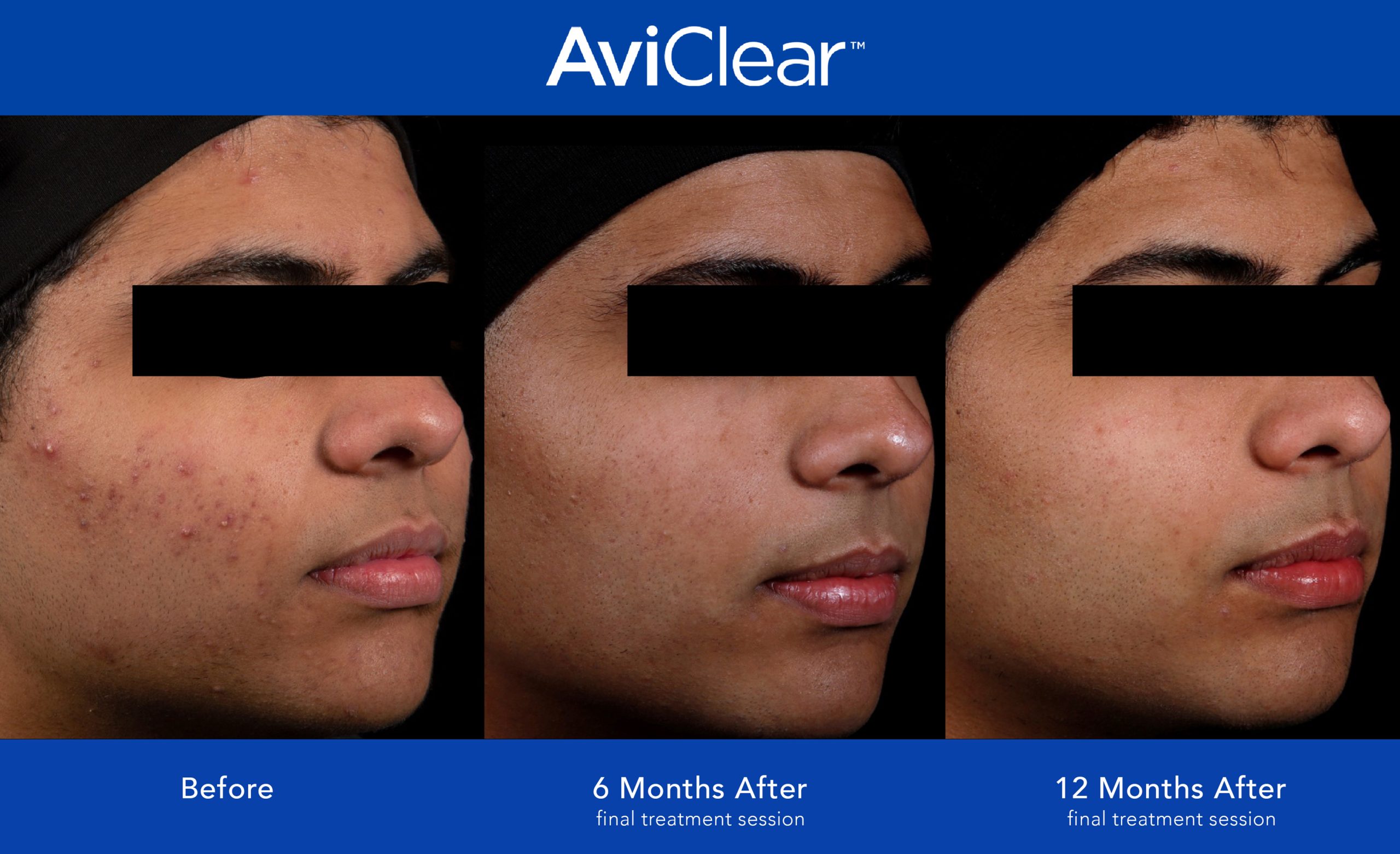 Before and After Photo 1 of AviClear® treatment at SF Bay Cosmetic Surgery Medical Group in San Ramon