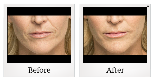 Before and After Photo 1 of Belotero Balance® treatment at SF Bay Cosmetic Surgery Medical Group in San Ramon