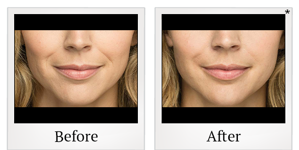 Before and After Photo 2 of Belotero Balance® treatment at SF Bay Cosmetic Surgery Medical Group in San Ramon
