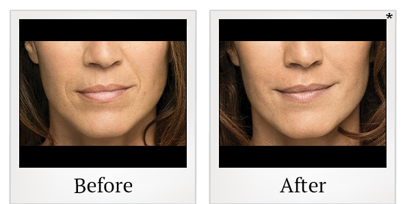 Before and After Photo 3 of Belotero Balance® treatment at SF Bay Cosmetic Surgery Medical Group in San Ramon